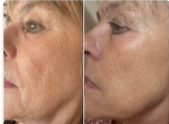 “Une vraie alternative aux injections…”