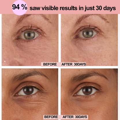GLOWZI  LIFT -Patchs Microneedle  Contour des Yeux
